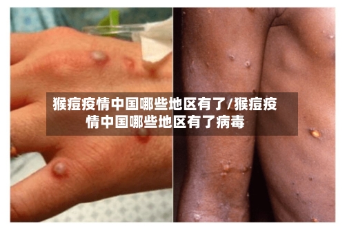 猴痘疫情中国哪些地区有了/猴痘疫情中国哪些地区有了病毒